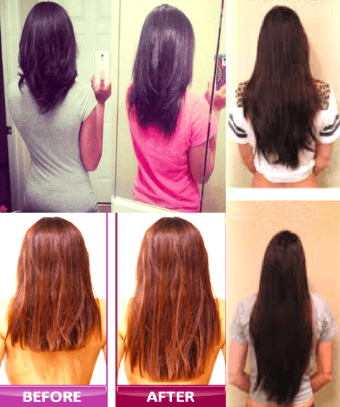 Home Hair Growth - Laser Device - WikiWii